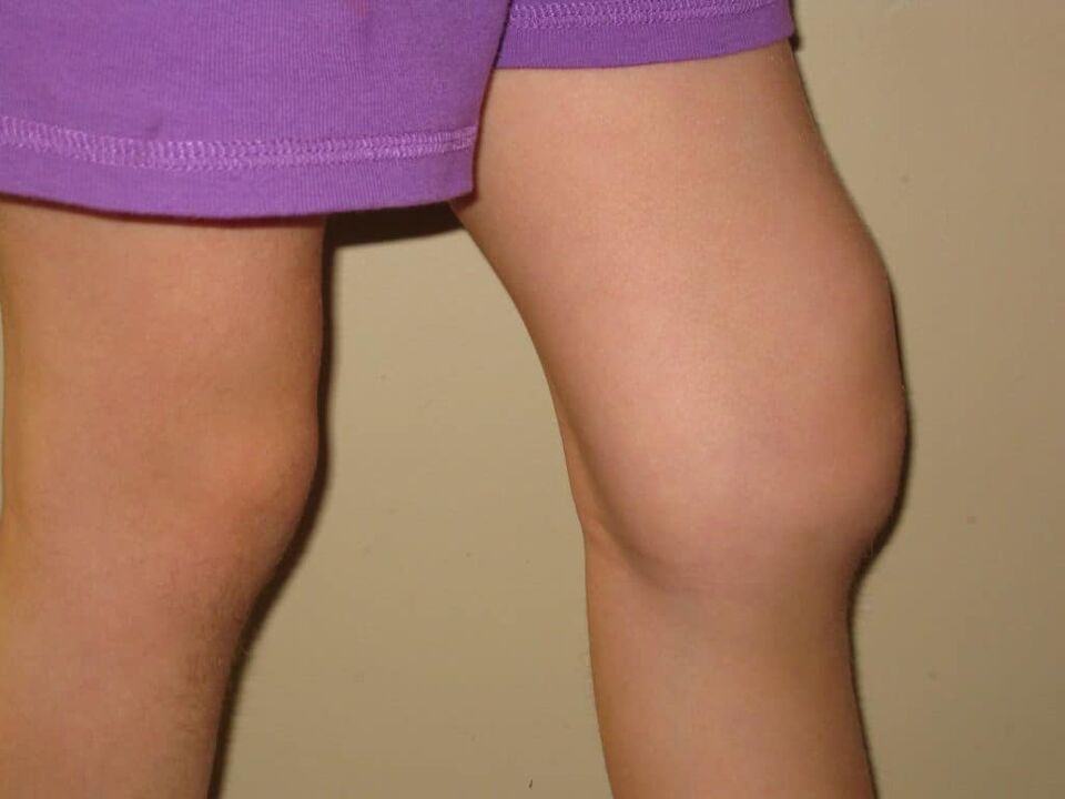 晚期关节病的膝关节病理学