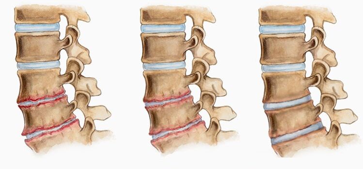 骨软骨病椎间盘变形可引起背痛