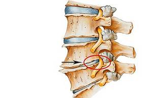 颈椎软骨病的病因导致脊柱夹伤